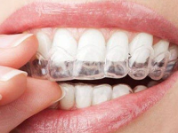 Achieving A Perfect Smile: The Magic Of Invisible Braces